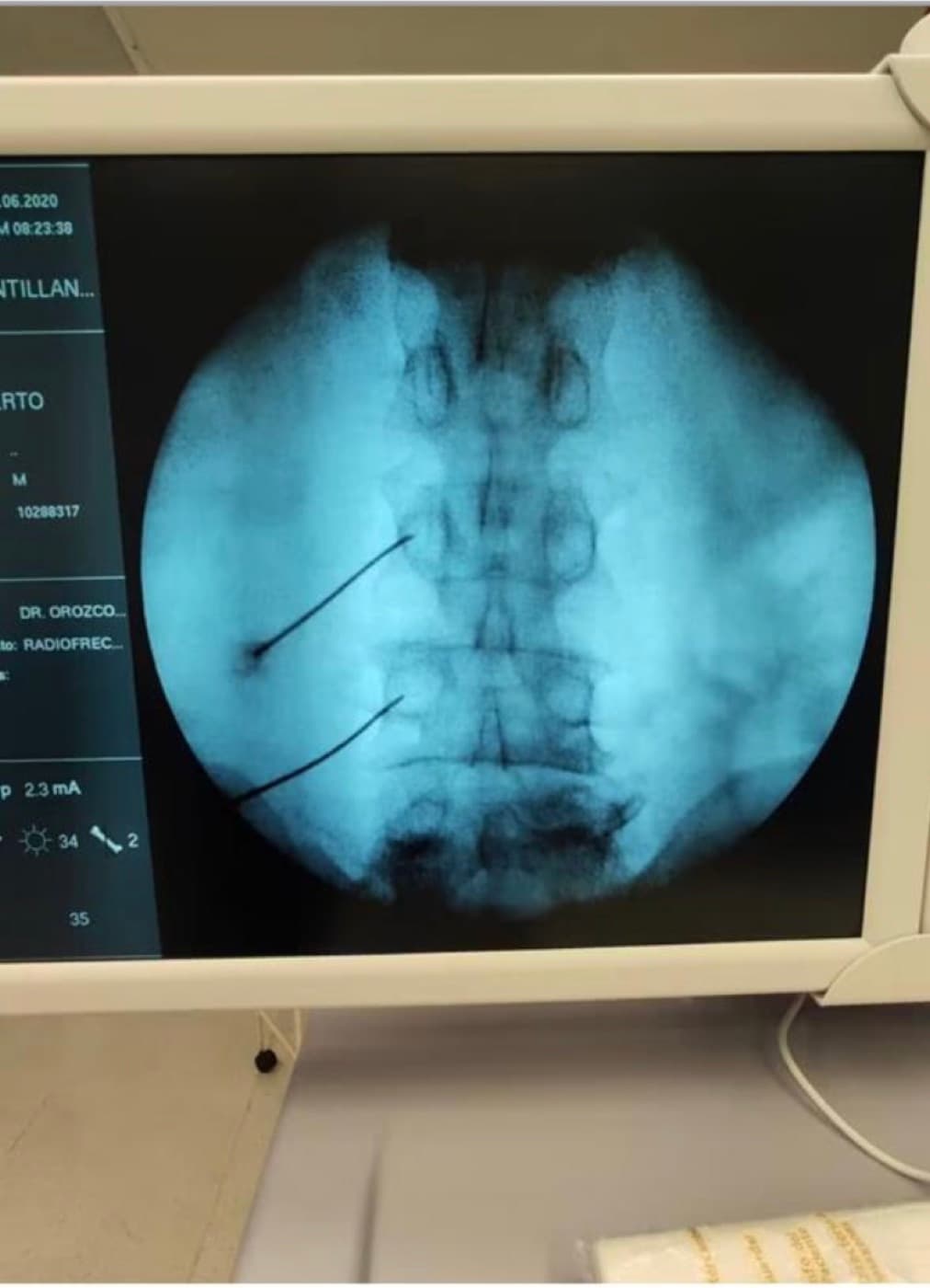 Procedimiento guiado por imagen para manejo del dolor