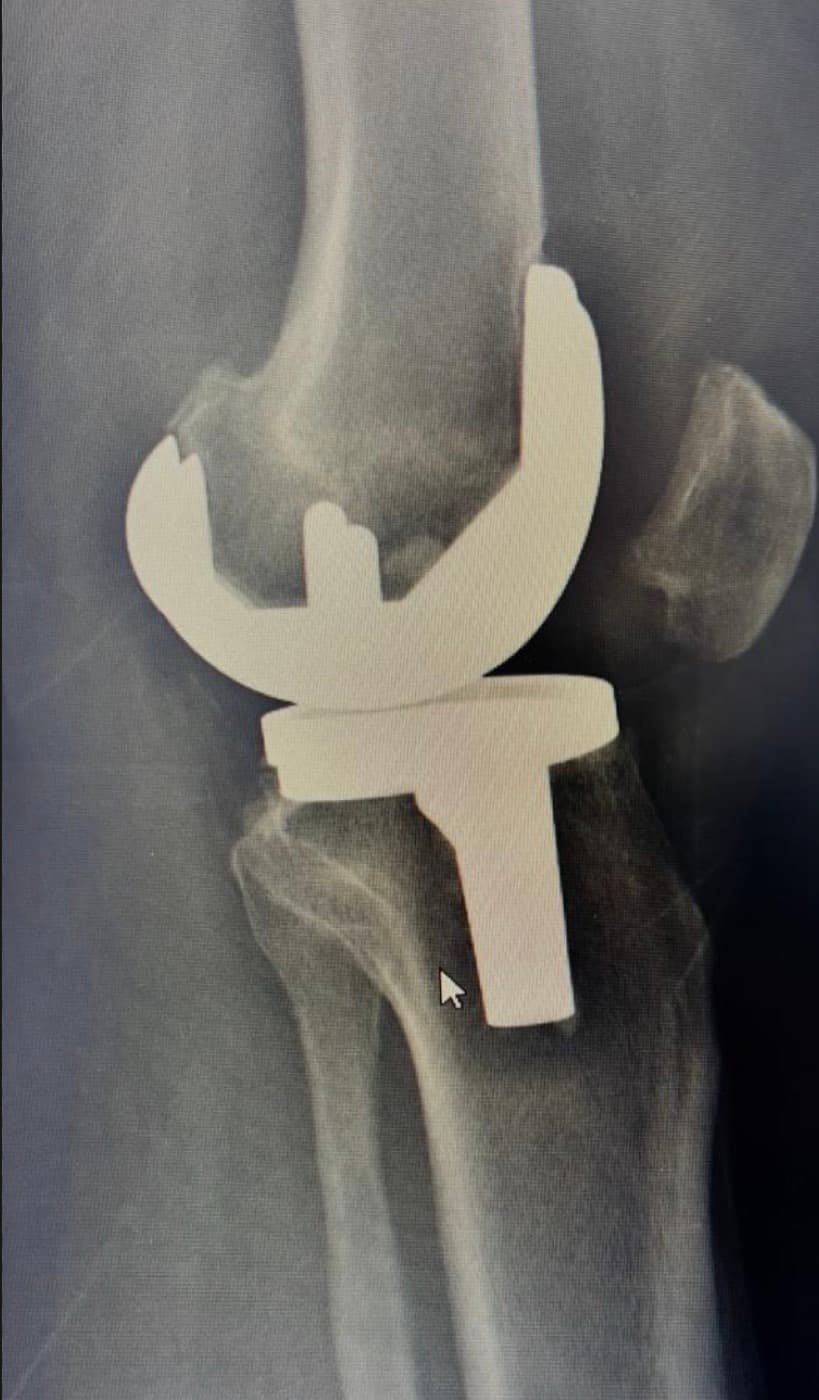 Radiografía de reemplazo protésico de rodilla